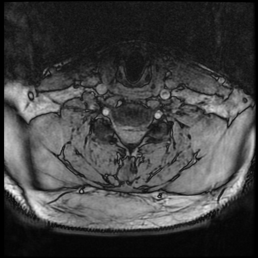 Cervical disc extrusion (Radiopaedia 59074-66364 G 67).jpg
