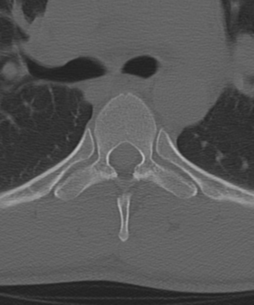 Cervical intercalary bone (Radiopaedia 35211-36748 Axial bone window 87).png