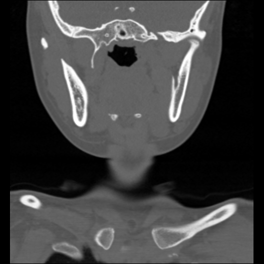 File:Cervical rib (Radiopaedia 71110-81363 Coronal non-contrast 39).jpg