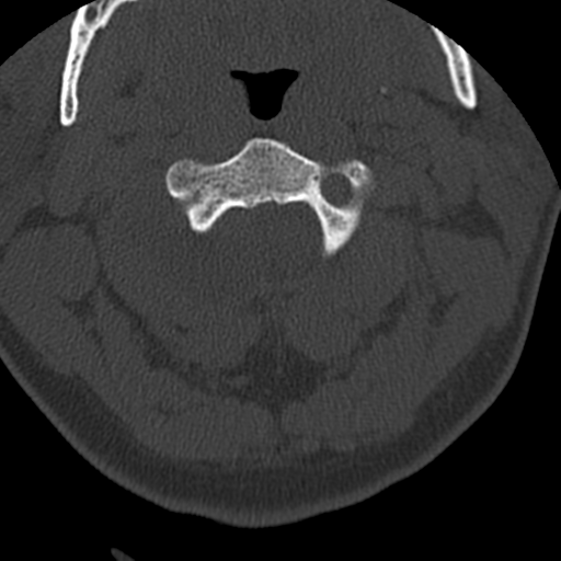 Cervical schwannoma (Radiopaedia 57979-64974 Axial bone window 15).png