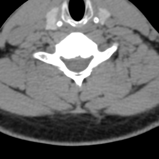 Cervical schwannoma (Radiopaedia 57979-64974 Axial non-contrast 46).png
