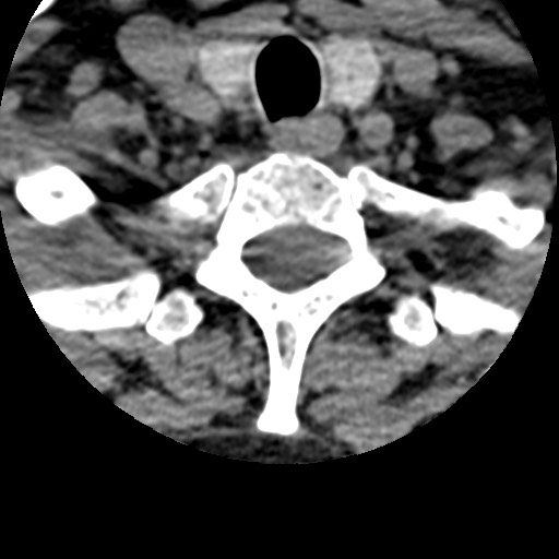 File:Cervical spinal neurofibroma in a patient with NF1 (Radiopaedia 58344-65464 Axial non-contrast 68).jpg