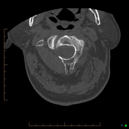 File:Cervical spine fracture - ankylosing spondylitis (Radiopaedia 76835-88706 Axial bone window 47).jpg