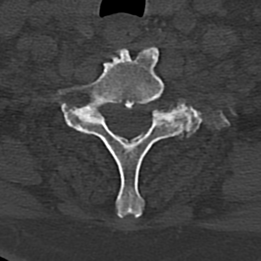 Cervical spine fracture - chalk stick (Radiopaedia 39116-41323 Axial bone window 74).png