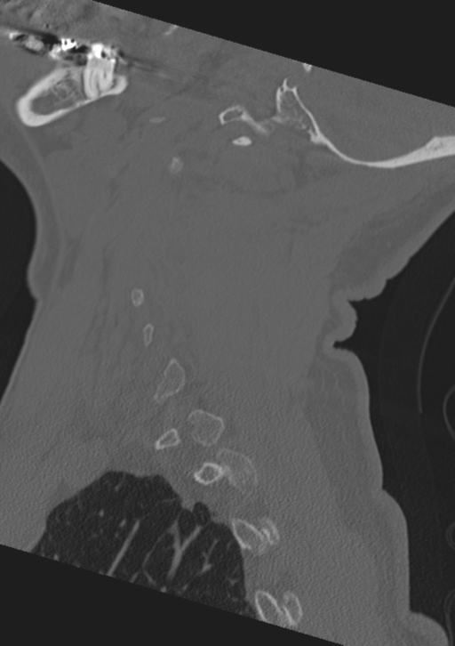 Cervical spine fractures with vertebral artery dissection (Radiopaedia 53296-59268 Sagittal bone window 55).png