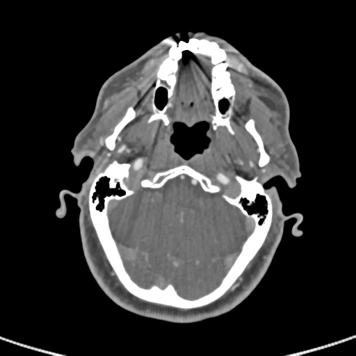 File:Cervical spine fractures with vertebral artery dissection (Radiopaedia 53296-59269 A 80).png
