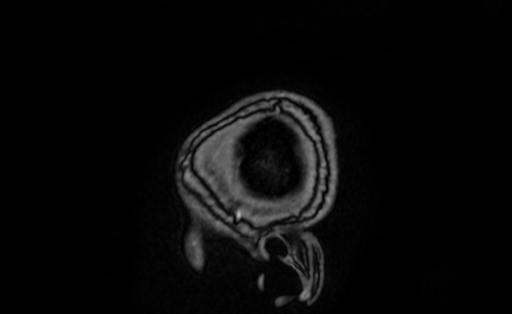 File:Cervical spondylodiscitis and calvarial hemangioma (Radiopaedia 64317-73103 Sagittal T1 C+ 1).jpg