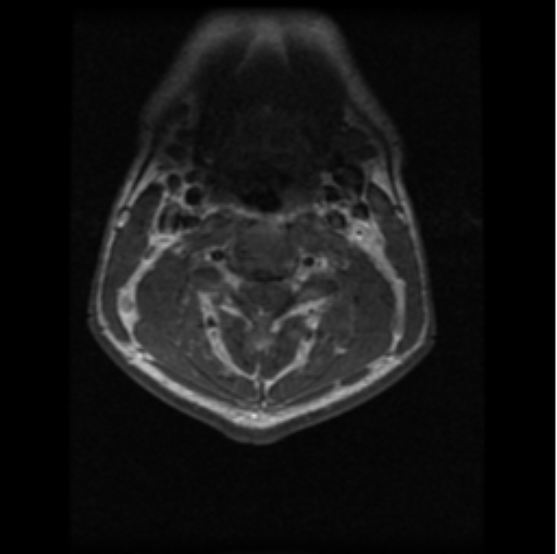 File:Cervical vertebrae metastasis (Radiopaedia 78814-91667 Axial T1 C+ 15).png
