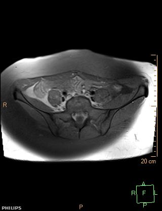 File:Cesarian scar endometriosis (Radiopaedia 68495-78066 Axial T1 fat sat 1).jpg