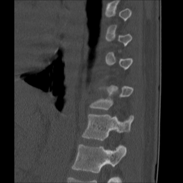 Chance fracture (Radiopaedia 36521-38081 Sagittal bone window 52).jpg