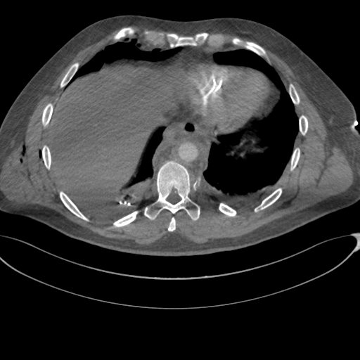 File:Chest multitrauma - aortic injury (Radiopaedia 34708-36147 A 228).png