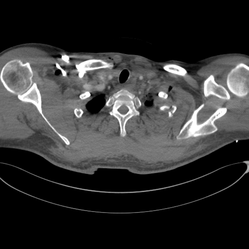 Chest multitrauma - aortic injury (Radiopaedia 34708-36147 A 26).png