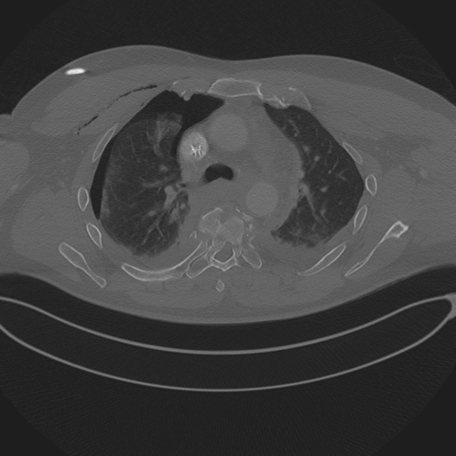 File:Chest multitrauma - aortic injury (Radiopaedia 34708-36147 Axial bone window 108).png