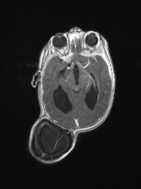 Chiari III malformation with occipital encephalocele (Radiopaedia 79446-92559 Axial T1 C+ mpr 45).jpg
