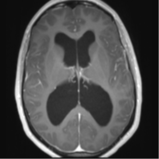 File:Chiari I malformation and obstructive hydrocephalus (Radiopaedia 41185-43978 Axial T1 C+ 18).png