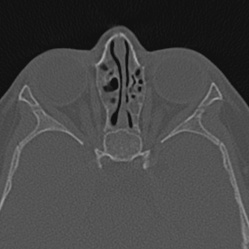 Choanal atresia (Radiopaedia 88525-105975 Axial bone window 77).jpg