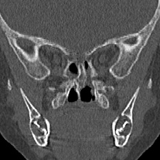 Choanal atresia (Radiopaedia 88525-105975 Coronal bone window 69).jpg