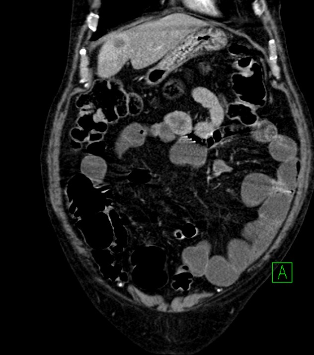 Cholangiocarcinoma with cerebral metastases (Radiopaedia 83519-98629 E 24).jpg