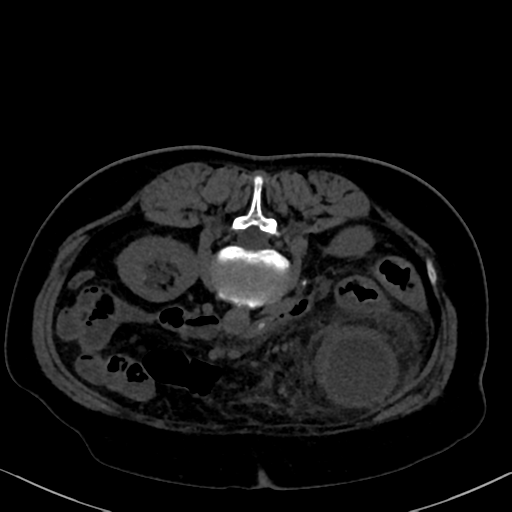 File:Cholecystitis - obstructive choledocholitiasis (CT intravenous cholangiography) (Radiopaedia 43966-47479 Axial 42).png