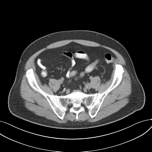 Cholecystitis with focal perforation and hepatic abscess (Radiopaedia 37189-38945 Axial non-contrast 65).png