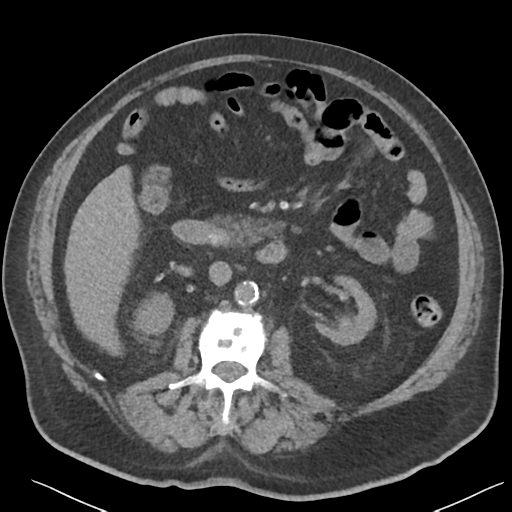 File:Choledocholithiasis and gastric polyp (Radiopaedia 48856-53895 Axial non-contrast 39).png