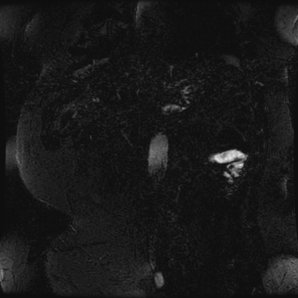 Choledocholithiasis on CT and MRI (Radiopaedia 24825-25088 Coronal T2 110).jpg