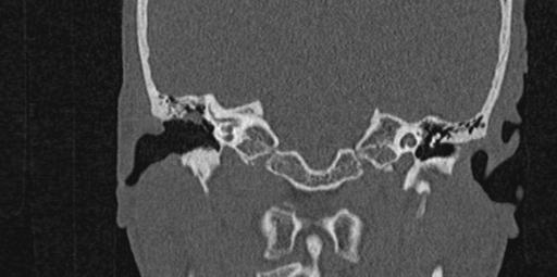 File:Cholesteatoma (Radiopaedia 70429-80529 Coronal bone window 7).jpg