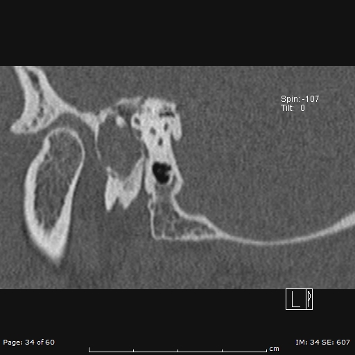Cholesteatoma - external auditory canal (Radiopaedia 88452-105096 Sagittal bone window 34).jpg