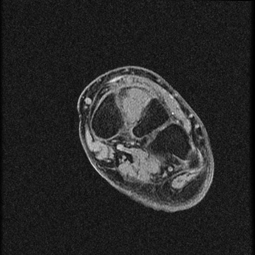 File:Chondroblastoma - midfoot (Radiopaedia 64831-73765 F 14).jpg