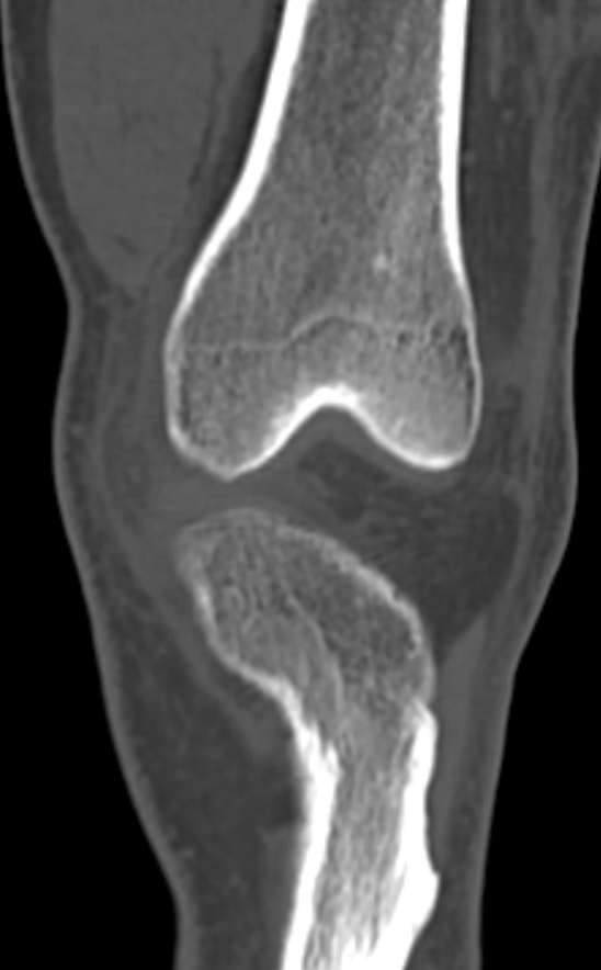Chondrocalcinosis (Radiopaedia 82862-97173 Coronal bone window 25).jpg