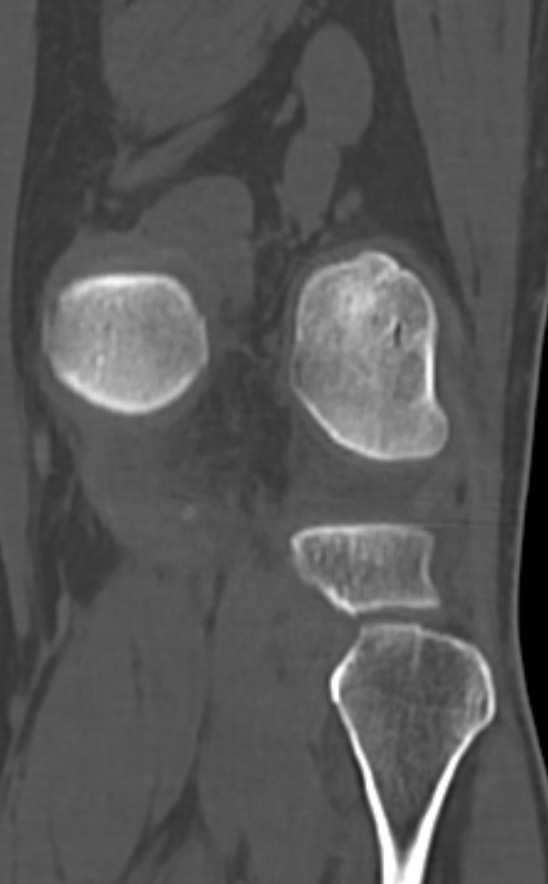 Chondrocalcinosis (Radiopaedia 82862-97173 Coronal bone window 62).jpg