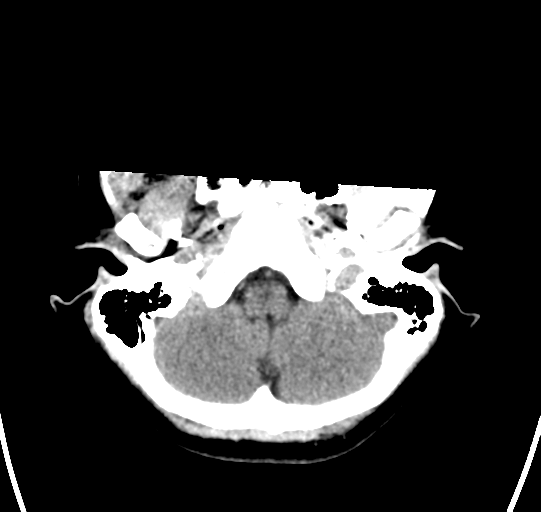 File:Chondrosarcoma (Radiopaedia 41937-44940 Axial non-contrast 6).png