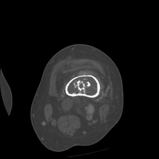Chondrosarcoma - femur (Radiopaedia 64187-72954 Axial bone window 23).jpg