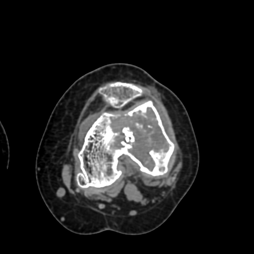 Chondrosarcoma - femur (Radiopaedia 64187-72954 Axial non-contrast 46).jpg