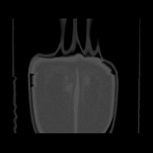 Chondrosarcoma of iliac wing (Radiopaedia 63861-72599 Coronal bone window 113).jpg