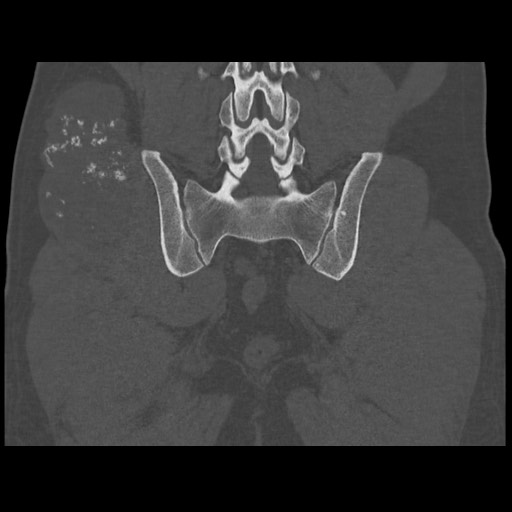 File:Chondrosarcoma of iliac wing (Radiopaedia 63861-72599 Coronal bone window 82).jpg