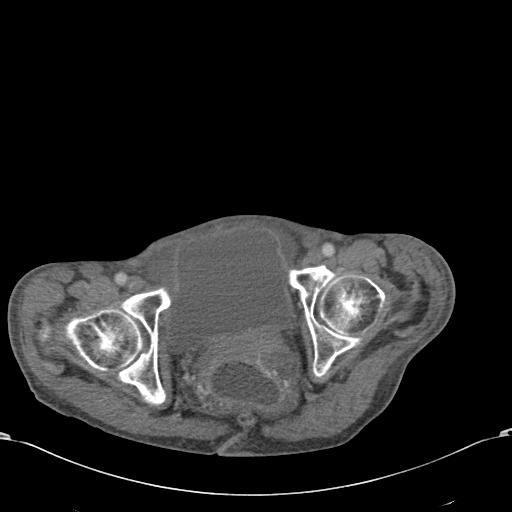 File:Chondrosarcoma of the spine (Radiopaedia 49871-55143 A 61).jpg