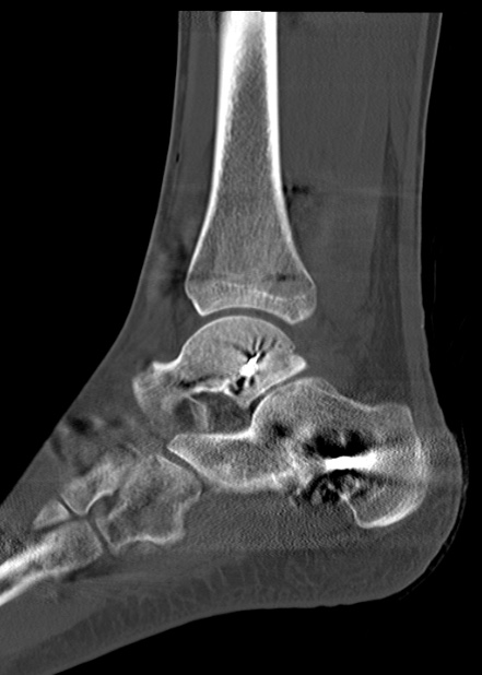 Chopart fracture (Radiopaedia 35347-36861 Sagittal bone window 46).jpg
