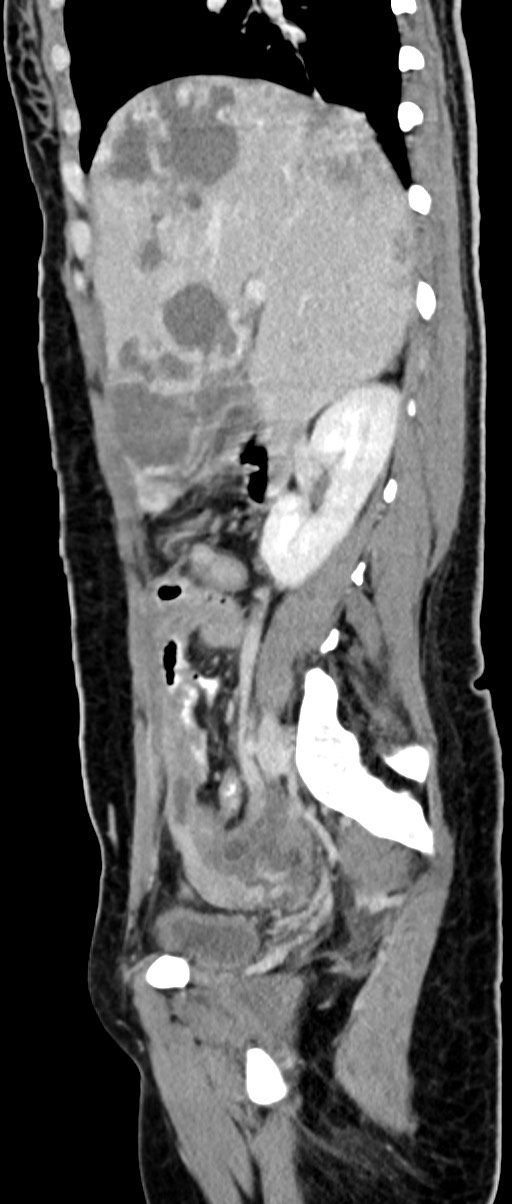 Choriocarcinoma liver metastases (Radiopaedia 74768-85766 C 117).jpg