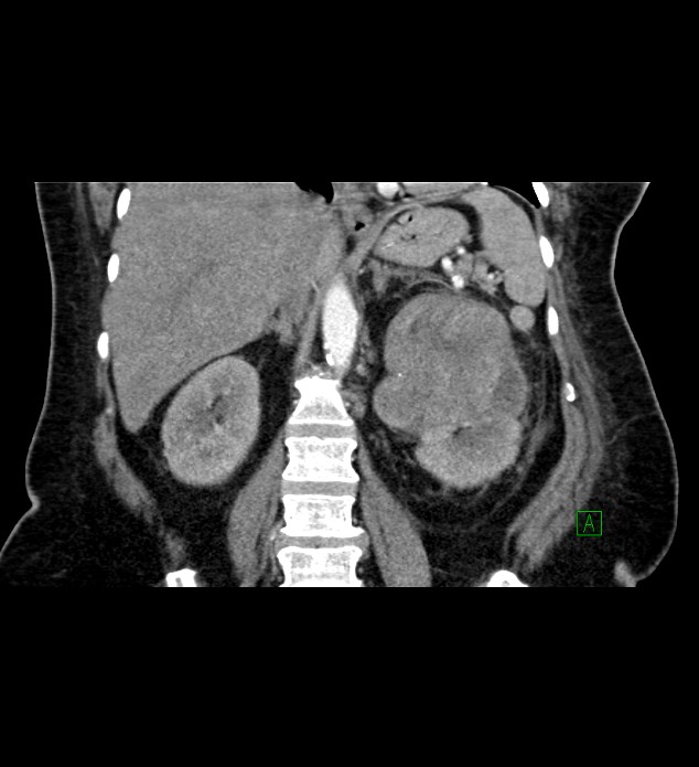 Chromophobe renal cell carcinoma (Radiopaedia 84239-99519 C 56).jpg
