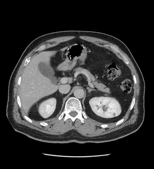 Chromophobe renal cell carcinoma (Radiopaedia 86879-103083 C 40).jpg