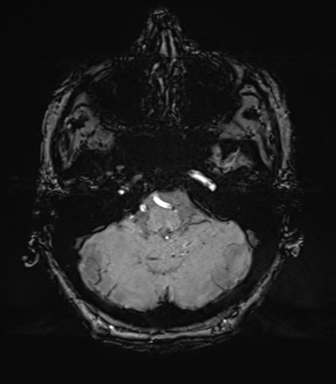 Chronic hypertensive encephalopathy (Radiopaedia 39993-42482 Axial SWI 16).png