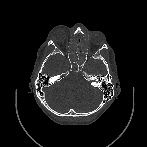 Chronic invasive fungal sinusitis (Radiopaedia 50342-55710 Axial bone window 75).jpg
