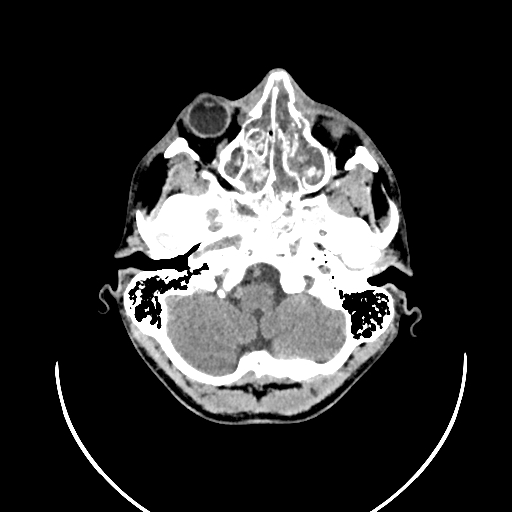 Chronic invasive fungal sinusitis (Radiopaedia 50342-55710 Axial non-contrast 33).jpg