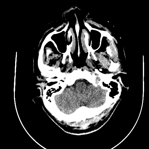 Chronic invasive fungal sinusitis (Radiopaedia 91563-109286 Axial non-contrast 6).jpg