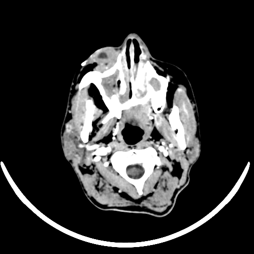Chronic invasive fungal sinusitis with intraorbital and intracranial extension (Radiopaedia 56387-63046 B 20).jpg