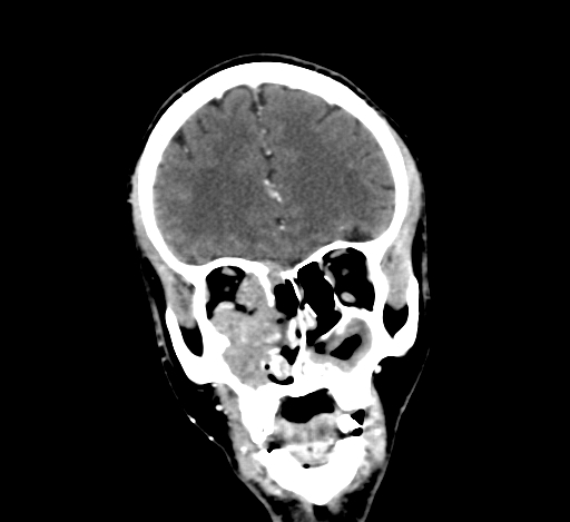 Chronic invasive fungal sinusitis with intraorbital and intracranial extension (Radiopaedia 56387-63046 C 110).jpg