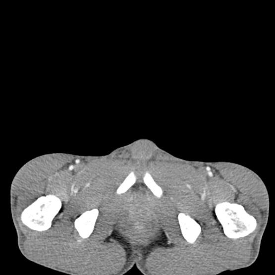 Chronic large bowel pseudo-obstruction (Radiopaedia 43181-46492 A 166).jpg