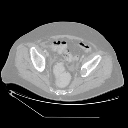 File:Chronic mesenteric ischemia - arterial (Radiopaedia 88205-104810 Axial lung window 44).jpg