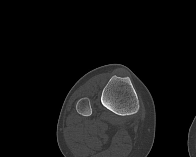Chronic ostemyelitis of the femur with long sinus tract (Radiopaedia 74947-85982 Axial bone window 250).jpg